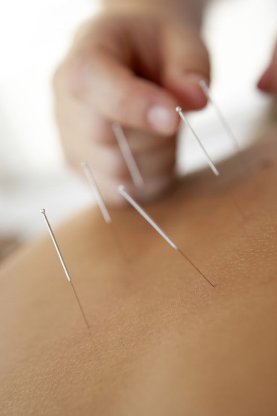 Illustratie bij: Zwanger worden makkelijker door acupunctuur: betere doorbloeding van je baarmoeder en eileiders